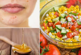 5 "nutrients for acne inflammation"
